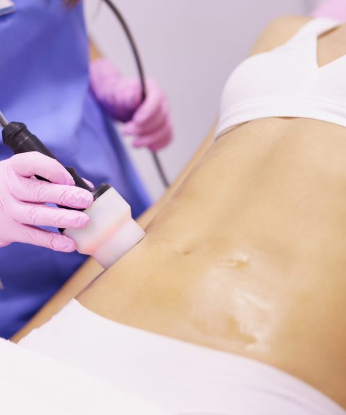 Middle-aged woman receiving anti-cellulite treatment with radiofrequency machine in an aesthetic clinic.